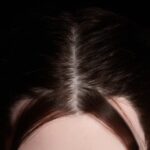 Pelo implantado +100,00&nbsp;&euro;